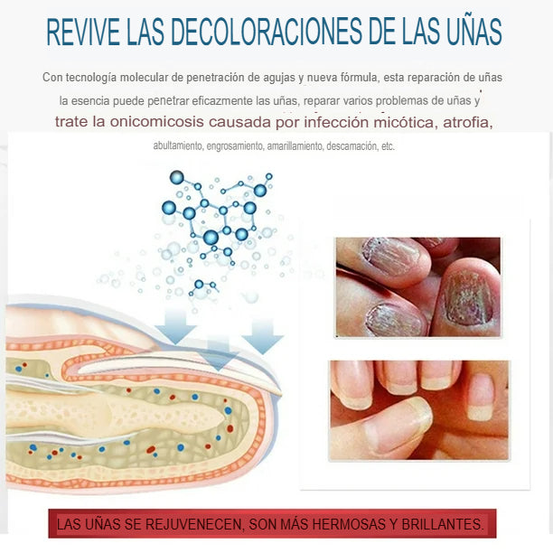 Tratamiento para Hongos - Paga 1 Lleva 2 unidades
