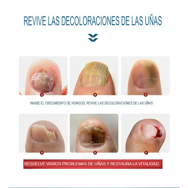 Tratamiento para Hongos - Paga 1 Lleva 2 unidades
